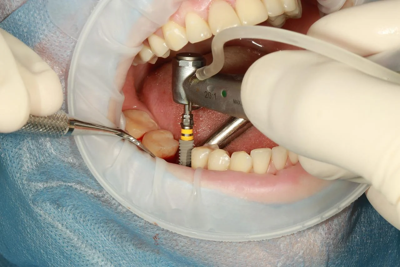 How Mini Dental Implants Differ From Regular Dental Implants – Health study notes