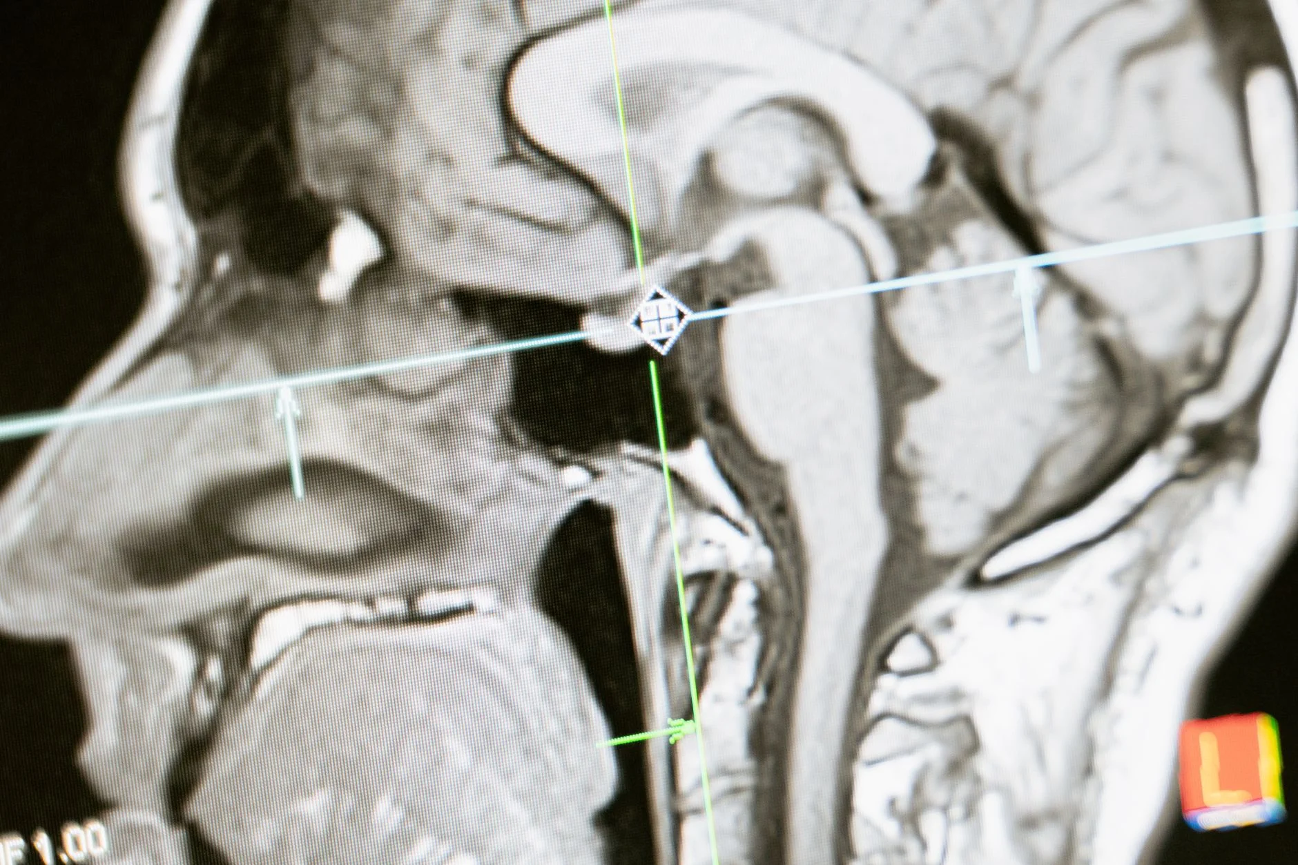 Close-up of an MRI scan showing a side view of the human brain on a screen